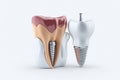 Anatomy of healthy teeth and tooth dental implant. ai generative Royalty Free Stock Photo