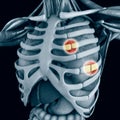 Anatomy and human body. Costochondral separation, separated rib. Broken, fractured ribs. Bones in the rib cage breaks or cracks