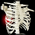 Anatomy and human body. Costochondral separation, separated rib. Broken, fractured ribs. Bones in the rib cage breaks or cracks