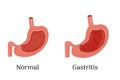 Anatomy of the human healthy and unhealthy stomach, medical poster with a detailed diagram of the structure from the Royalty Free Stock Photo