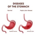 Anatomy of the human healthy and unhealthy stomach