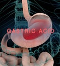 Anatomy illustration of gastric acid or heartburn, inflamed red stomach showing acid in red. Royalty Free Stock Photo