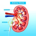 Anatomy of kidney stone in blue