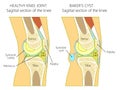 Anatomy of the knee_Baker`s cyst Royalty Free Stock Photo