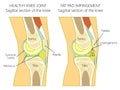 Anatomy of the knee_Fat pad impingement due to hyperextension