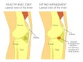 Anatomy of the knee_Fat pad impingement syndrome Royalty Free Stock Photo