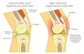 Anatomy of the knee_synovitis Royalty Free Stock Photo