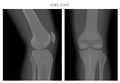 Anatomy of the knee_X Ray knee side and front