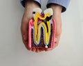 Anatomy mockup of section of tooth with caries in children hands