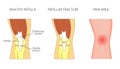 Anatomy_Patellar fracture