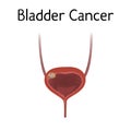 Anatomy picture of bladder cancer. Realistic medical illustration