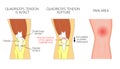 Anatomy_Quadriceps tendon rupture