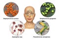 Anatomy of rhinosinusitis and microorganisms that cause sinusitis