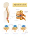 Anatomy Spinal Hernia Infographics