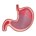 Anatomy of the Stomach in Acid Reflux, GERD Royalty Free Stock Photo