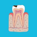 Anatomy of Unhealthy tooth with tooth decay isolated cross section. Medical dental poster illustration in flat design.