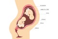 Anatomy of the uterus with twin fetuses. Placement of dizygotic twins. flat illustration Royalty Free Stock Photo