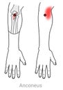 Anconeus: pain in the elbow from myofascial trigger points.