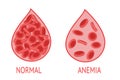 Anemia. Comparison of a drop of blood with normal and anemic blood cells