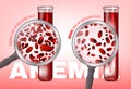 Anemia level of blood cells