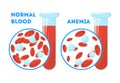 The Anemia symptoms. Normal and anemia blood