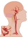 Aneurisma fusiforme cerebral