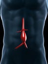 Aneurysm of the aorta Royalty Free Stock Photo