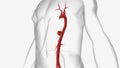 An aneurysm is the ballooning expansion of a blood vessel due to weakened structure or damage to the vessel wall.