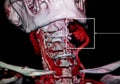 Aneurysm carotid aretery. CT-scan reconstruction.