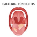 Angina, pharyngitis, and tonsillitis. Tonsil infection. Open Mouth.