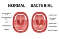 Angina, pharyngitis, and tonsillitis. Tonsil infection. Open Mouth.