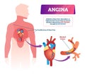 Angina vector illustration. Labeled medical chest pain and heart problem. Royalty Free Stock Photo