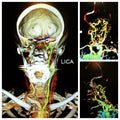 Angio neuro ct neck exam acute left cerebral infarction
