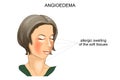 Angioedema. allergic swelling Royalty Free Stock Photo