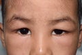 Angioedema at eyelids of Asian male child. Puffy face. Edematous child. Caused by nephritis, nephrotic syndrome, drug, seafood or
