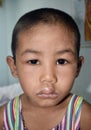 Angioedema at eyelids and lips of Asian male child. Puffy face. Edematous child. Caused by nephritis nephrotic syndrome drug 