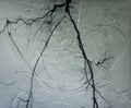 Angiogram of pelvic vessels