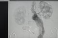 Angiogram renal artery after coil embolization procedure. X-ray images of Angiogram was performed right renal artery