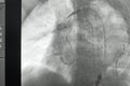 Angiogram of right common iliac artery after aortic stent graft deployed at infra renal abdominal aortic aneurysm