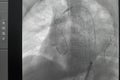 Angiogram of right common iliac artery after aortic stent graft deployed at infra renal abdominal aortic aneurysm during