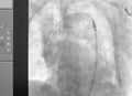 Angiogram of right common iliac artery after aortic stent graft deployed at infra renal abdominal aortic aneurysm during