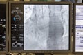 Angiogram sequence working clockwise using x-rays with a contrast agent injected from a tube inserted into the arteries (left &