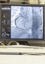 Angiogram sequence working clockwise using x-rays with a contrast agent injected from a tube inserted into the arteries (left &