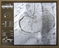 Angiogram sequence working clockwise using x-rays with a contrast agent injected from a tube inserted into the arteries (left &