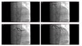 Angiogram