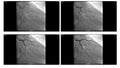 Angiogram