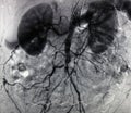 Angiography of Aorta and Branches
