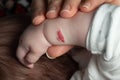 Angioma or pink hemangioma on the arm of a two-month-old baby
