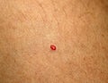 Angioma. Red mole on the body. Birthmark on skin