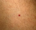 Angioma. Red mole on the body. Birthmark on skin